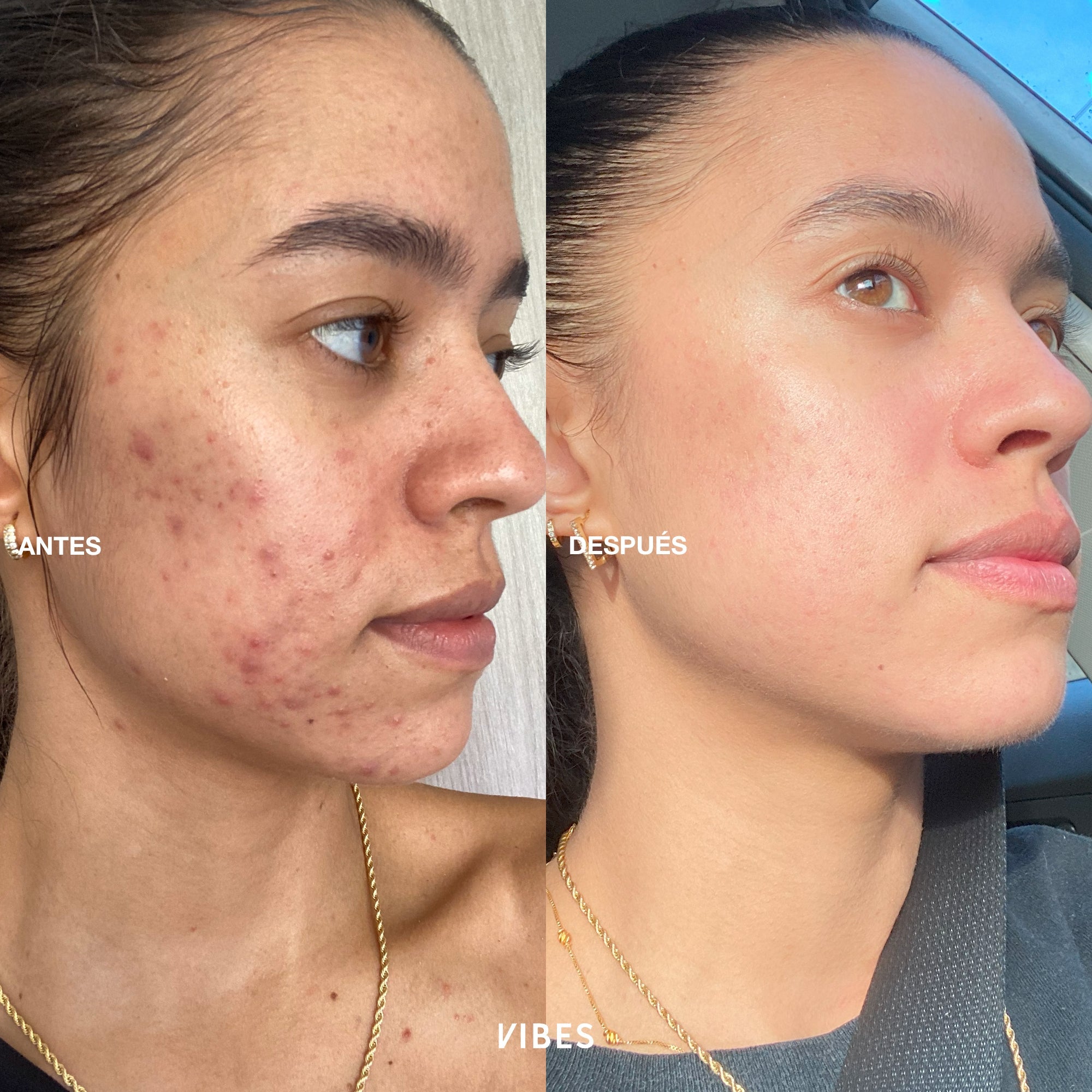 VIBES SERUM PARA BARROS Y CONTROL DE GRASA CON NIACINAMIDA MINDBLOWING 35ML